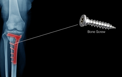 接骨螺钉梅花铣削.png 接骨螺钉梅花铣削.png